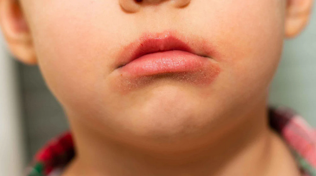 الأسباب الشائعة لتقشر الشفاه